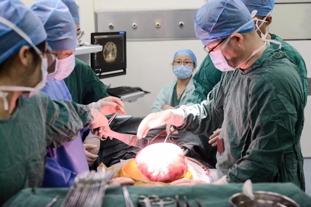 精湛技术l6旬老汉肚大如孕妇，手术成功 取出重达20斤巨大肿瘤